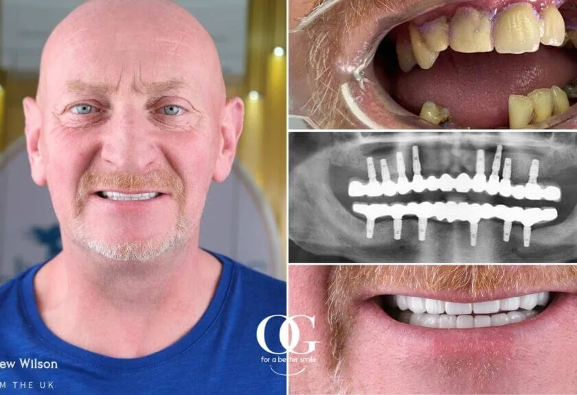 Behandlungsergebnis der OG Dental Clinic