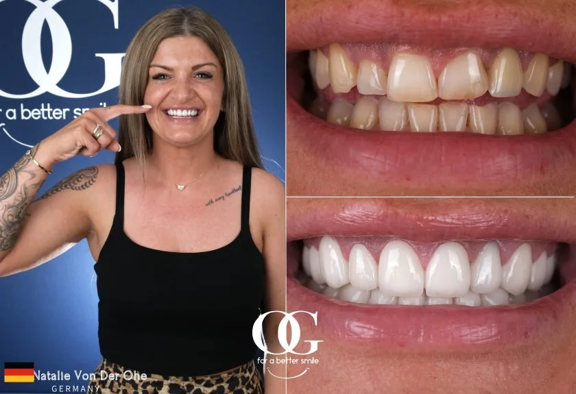 Behandlungsergebnis der OG Dental Clinic
